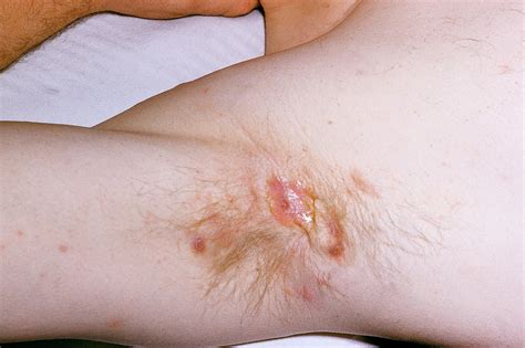 photos of armpit lumps|hidradenitis suppurativa pictures.